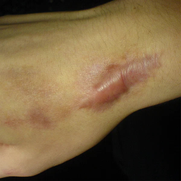 Keloid Scars