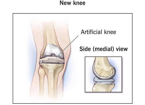 new knee