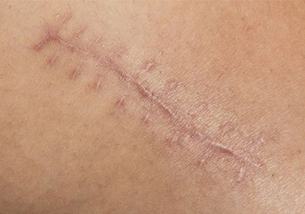 surgical scar