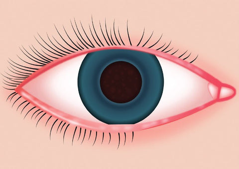 blepharitis eyelash extensions