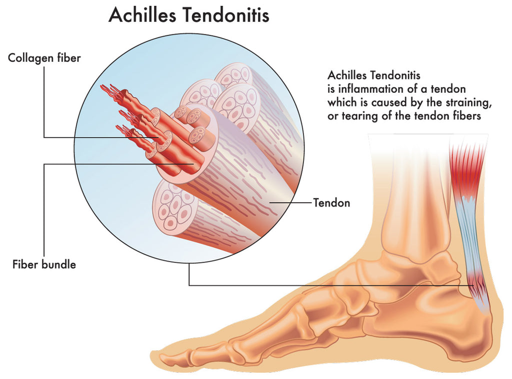 Achilles Tendonitis Infographic