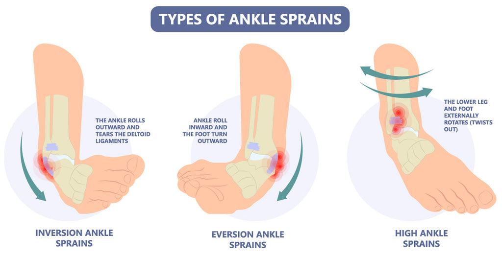 Ankle Sprains: A Comprehensive Guide for Quick Recovery – GatsbyShoes