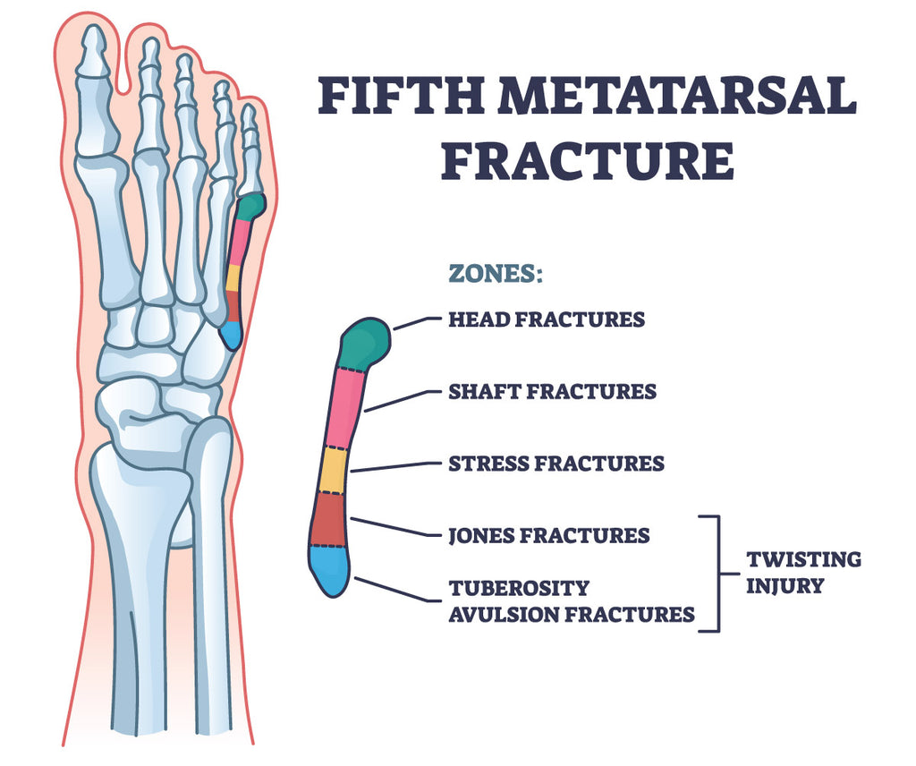 Fifth metatarsal stress fracture info-graphic