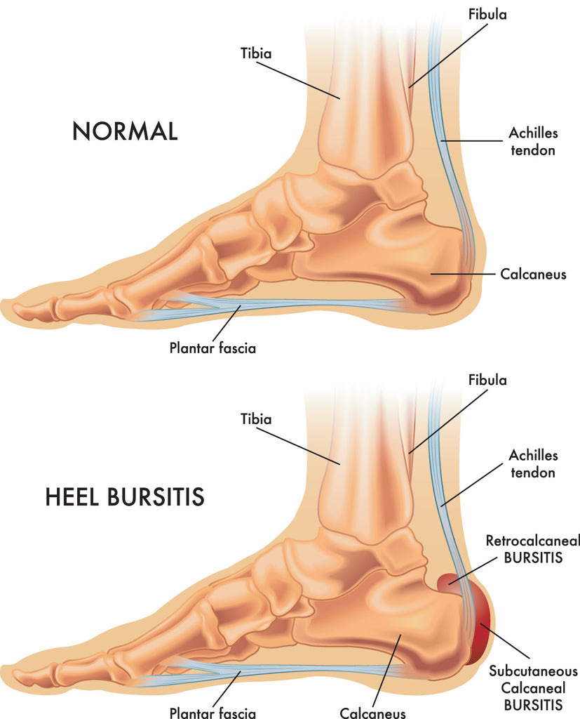 infographic showing the difference between a normal foot and one with heel bursitis