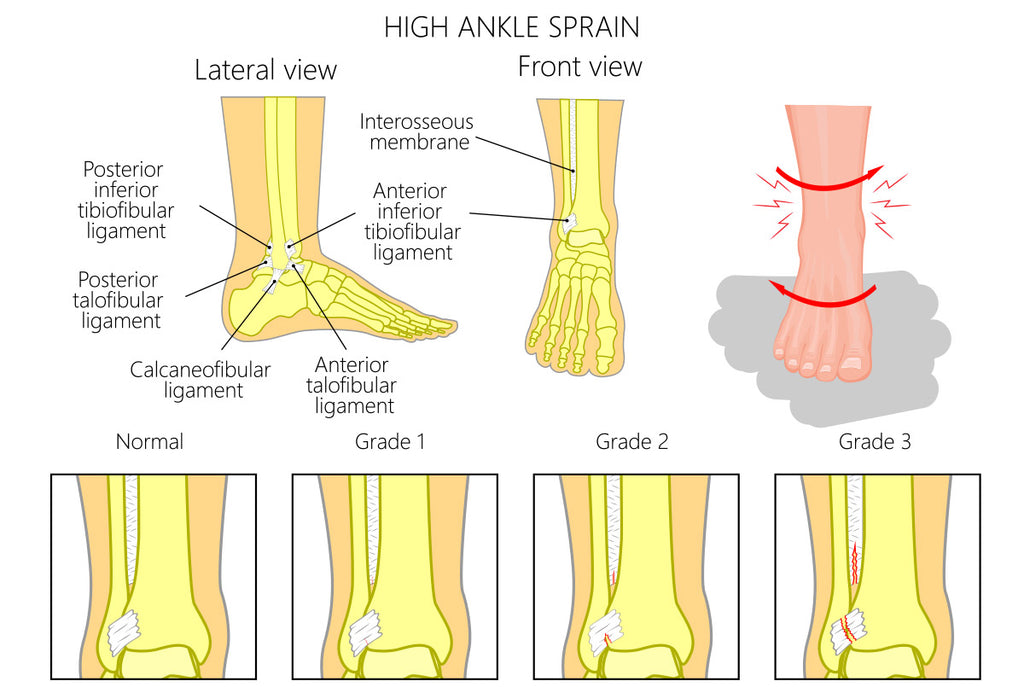 High Ankle Sprain Illustration