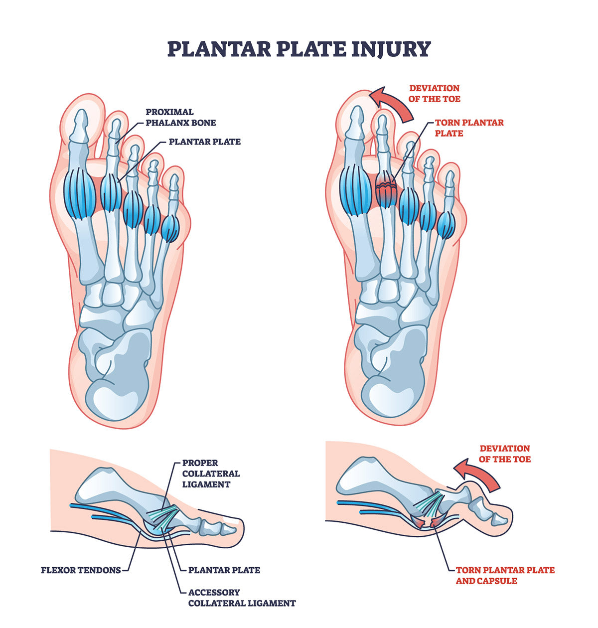 medical chart showing symptoms of plantar plate tear