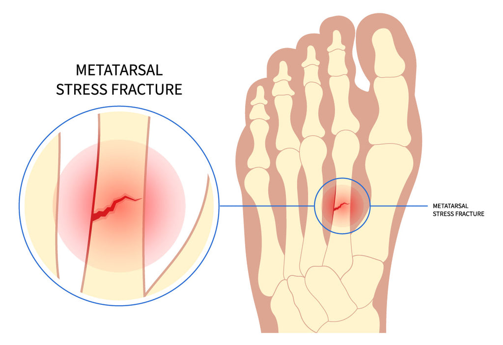 Stress Fracture Image
