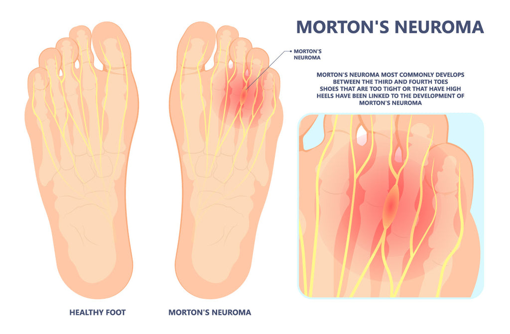 mortons neuroma infographic
