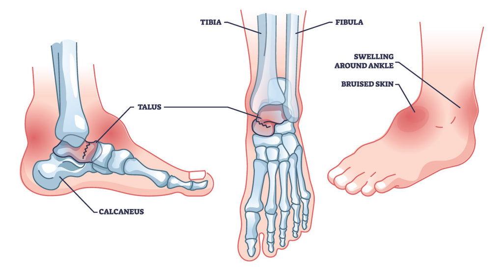 Talus Fracture Infographic