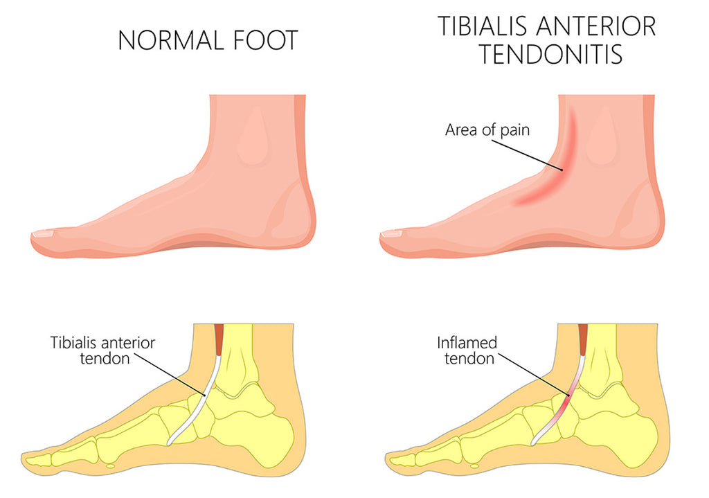 Anterior Tibial Tendonitis: Causes, Symptoms, and Treatment Options ...