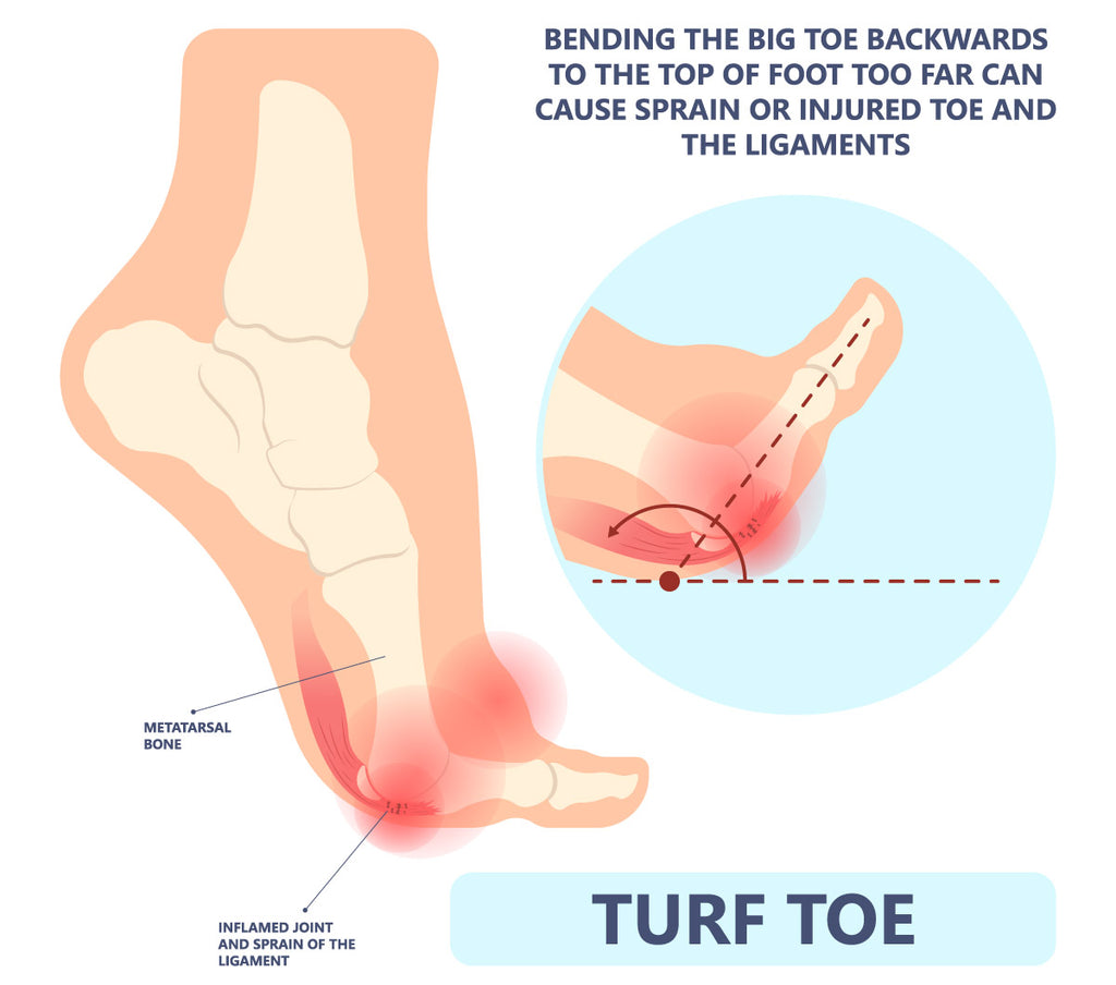 turf toe infographic