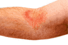 radiation burn on an arm