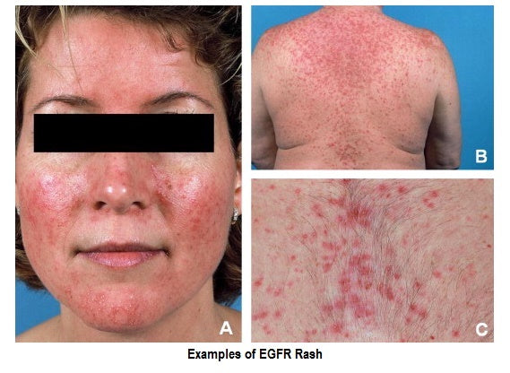 EGFR Rash