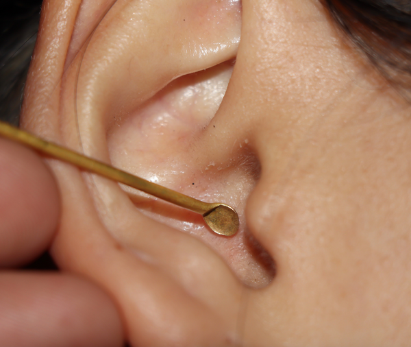 A person with ear canal and wet earwax