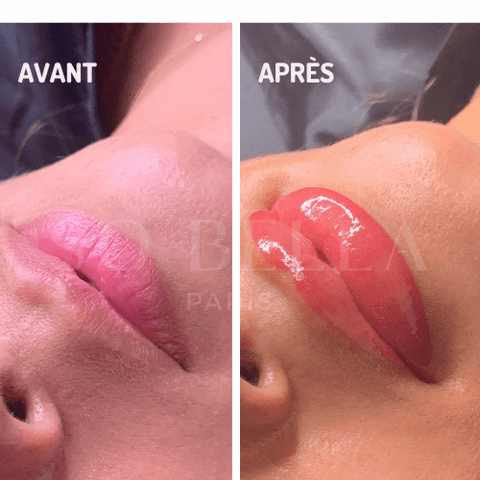 Foto de antes y después de unos labios dulces en una de nuestras clientas.