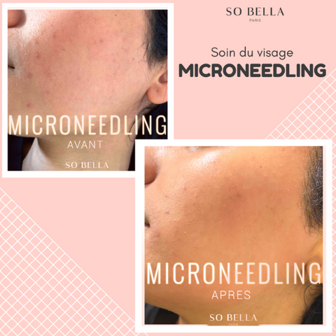 Microblading antes después 2