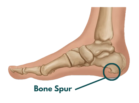 Bone Spur in the heel