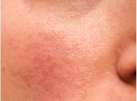 Skin rash on cheek from negative skin reaction 