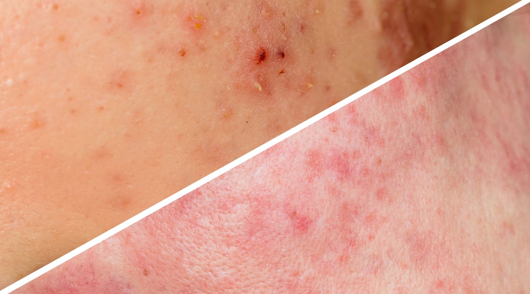 como identificar se tenho acne ou rosácea?