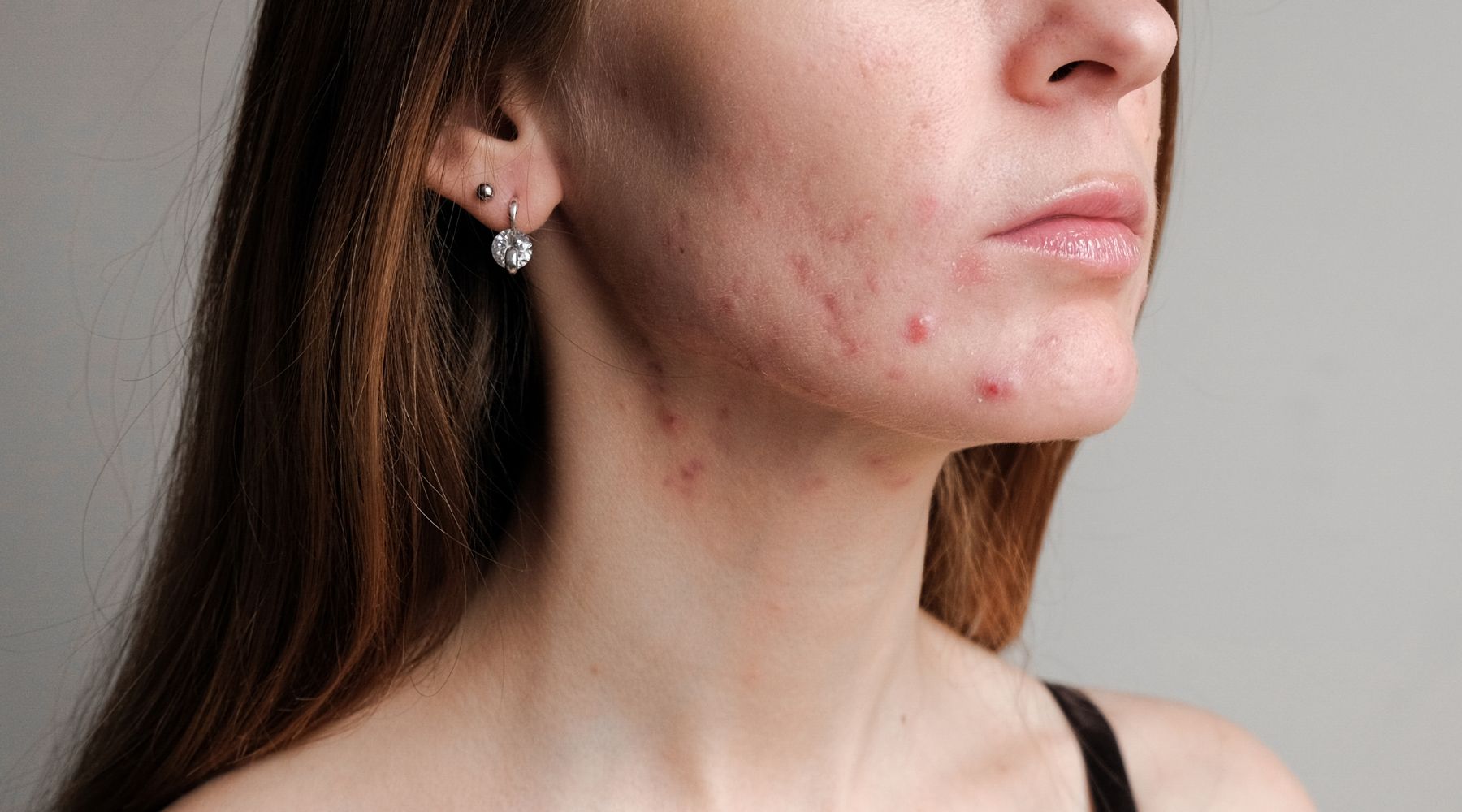 Pele com acne