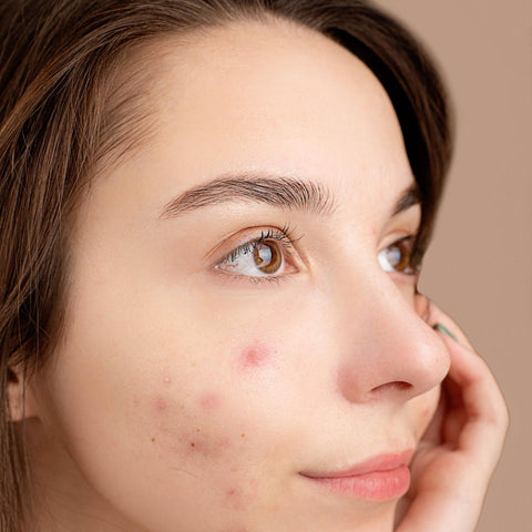Lady with Acne