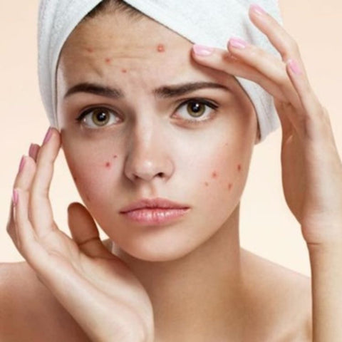 Lady with Acne