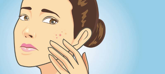 Why Do We Get Acne Scars?