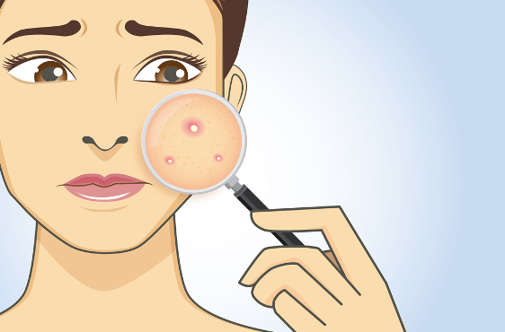How to Remove Acne Scars- Treatment Options