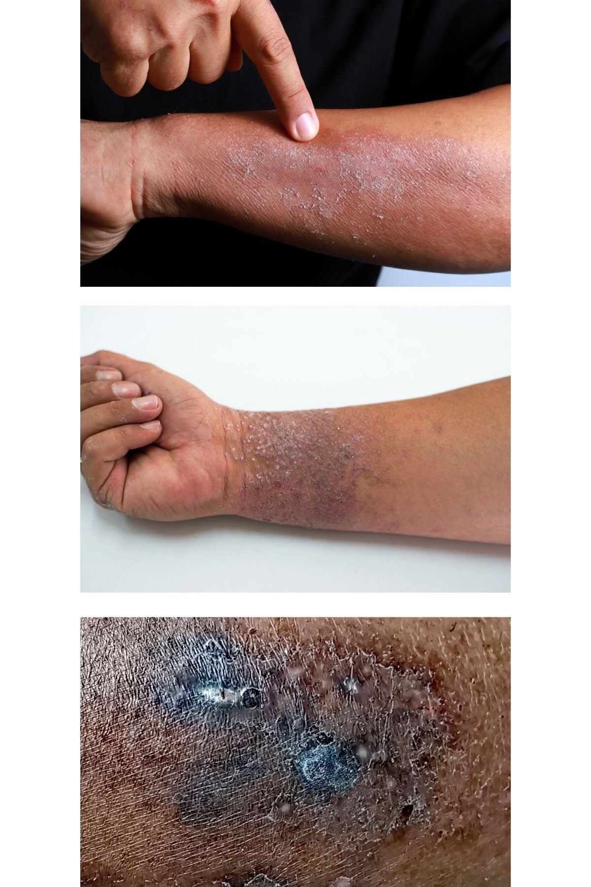 eczema examples on dark skin