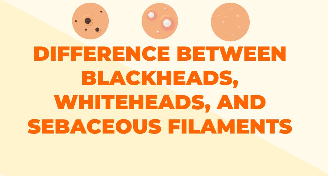 difference between blackheads, whiteheads, and sebaceous filaments infographic