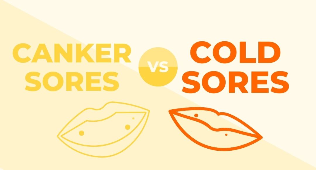 canker sores vs cold sores infographic