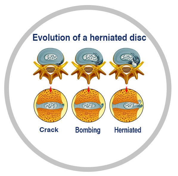 herniated disc