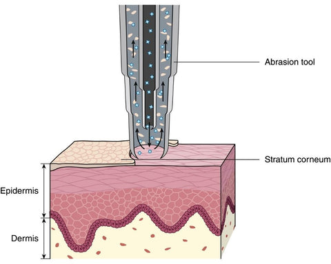 crytal microdermabrasion 