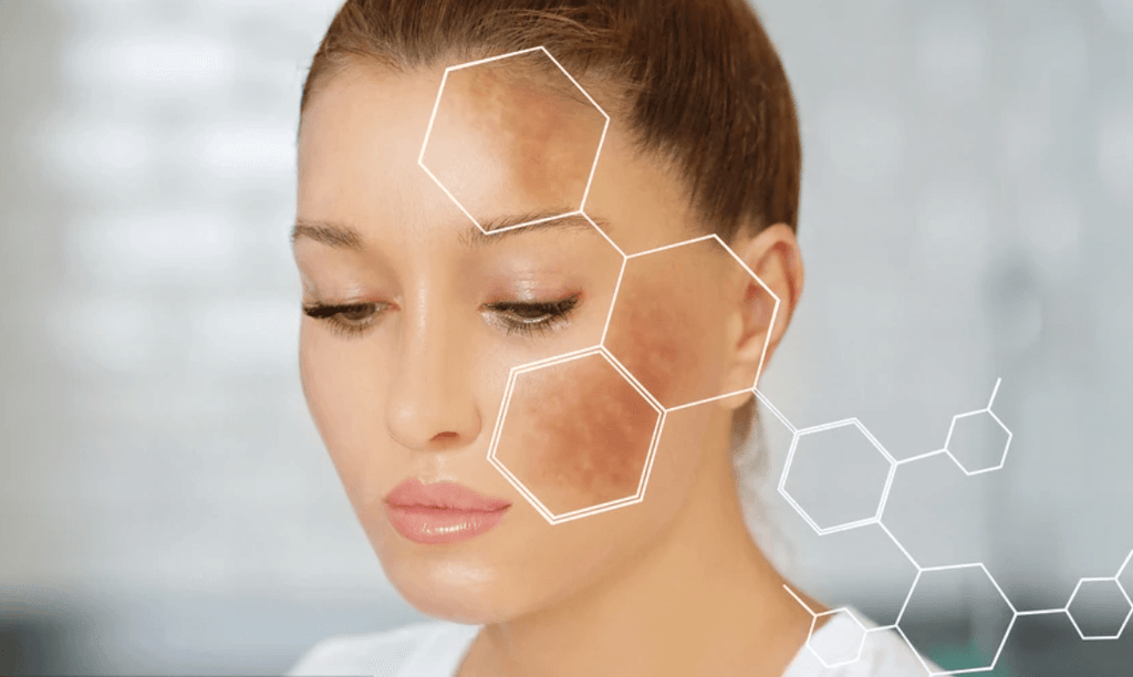 how to get rid of hyperpigmentation on face