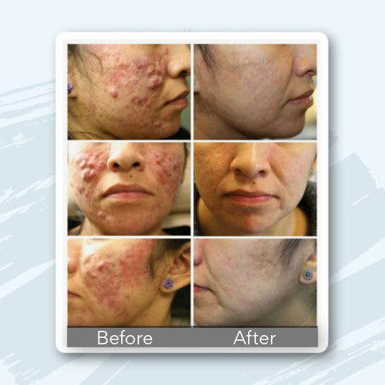 Schedule Now! NeoClear Acne Laser Therapy Knoxville, TN