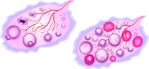 polycystic-ovary