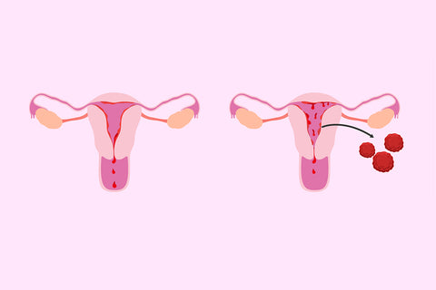 why-do-i-have-clots-during-my-menstruation-1