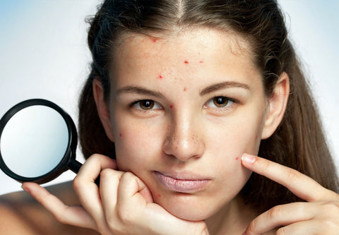 pimples-during-menstruation-2