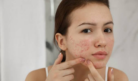 How to Treat Your Winter Acne In Simple Ways