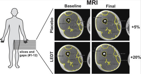 MRI von Muskelzuwachs Zwillingsstudie von Photobiomodulation mit PBM