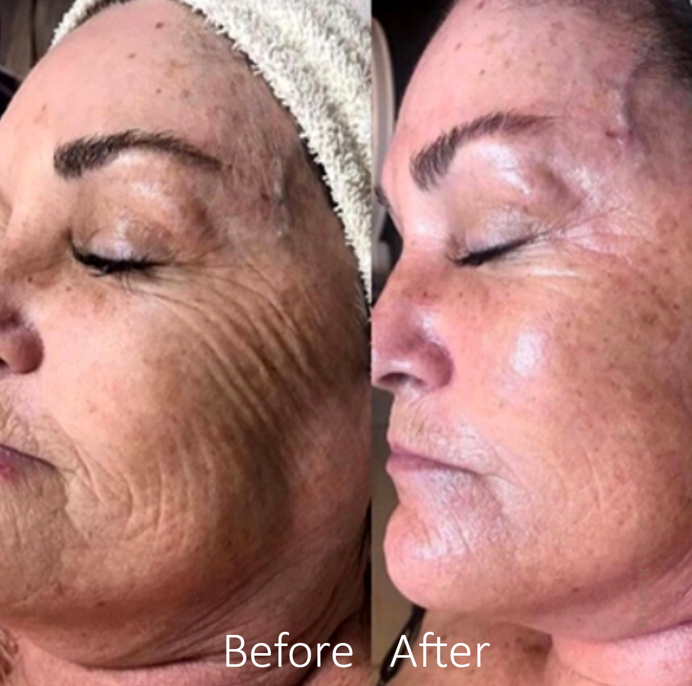 JetPeel facial treatment at Monterella Spa