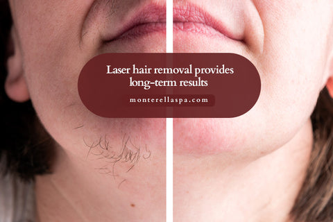 Laser hair removal provides long-term results 