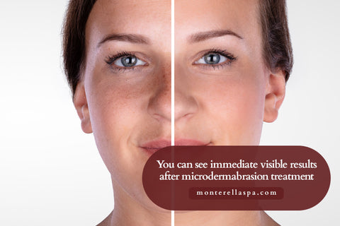 You can see immediate visible results after microdermabrasion treatment.