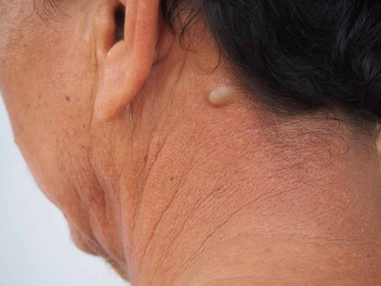 What Are The Treatments For Sebaceous Cyst