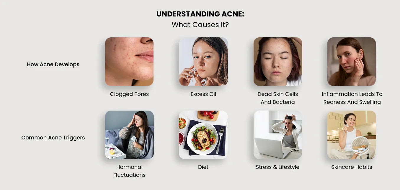 How Acne Develops