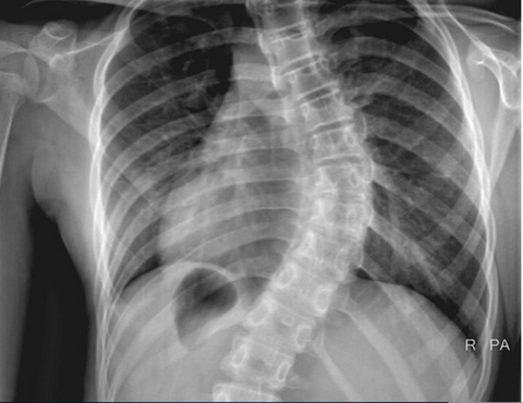 scoliosis image