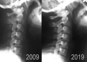 10 Year Challenge of Military neck