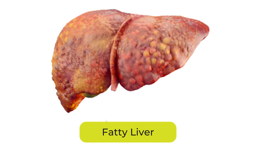 Fatty Liver