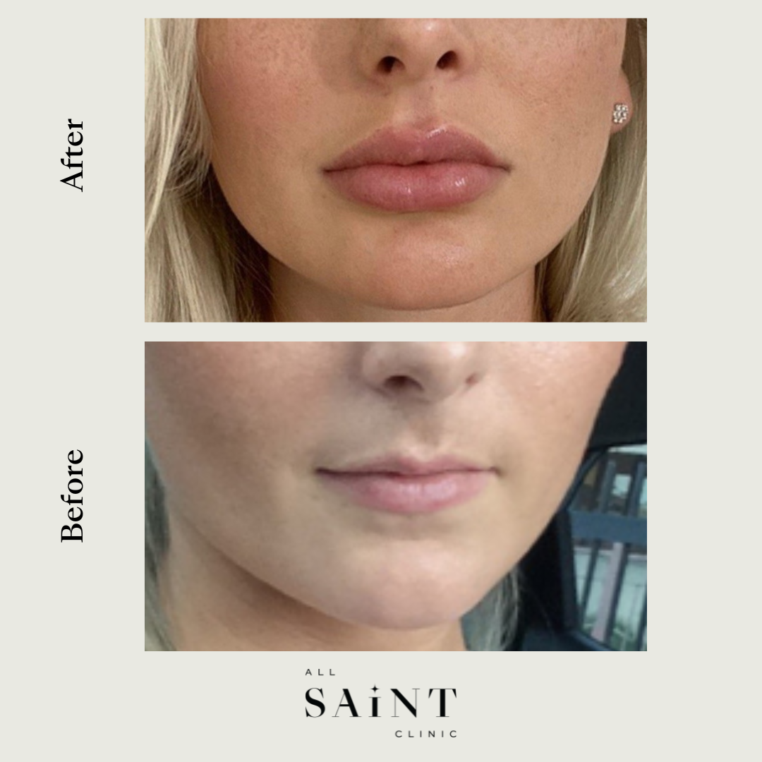 Dermal Fillers Sydney - Before and After Results
