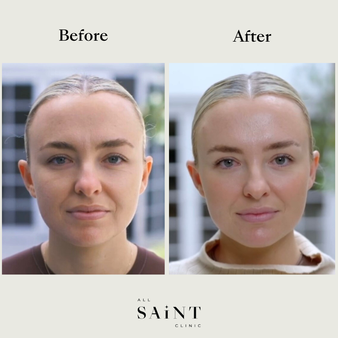 Botox Sydney - Women's Before and After